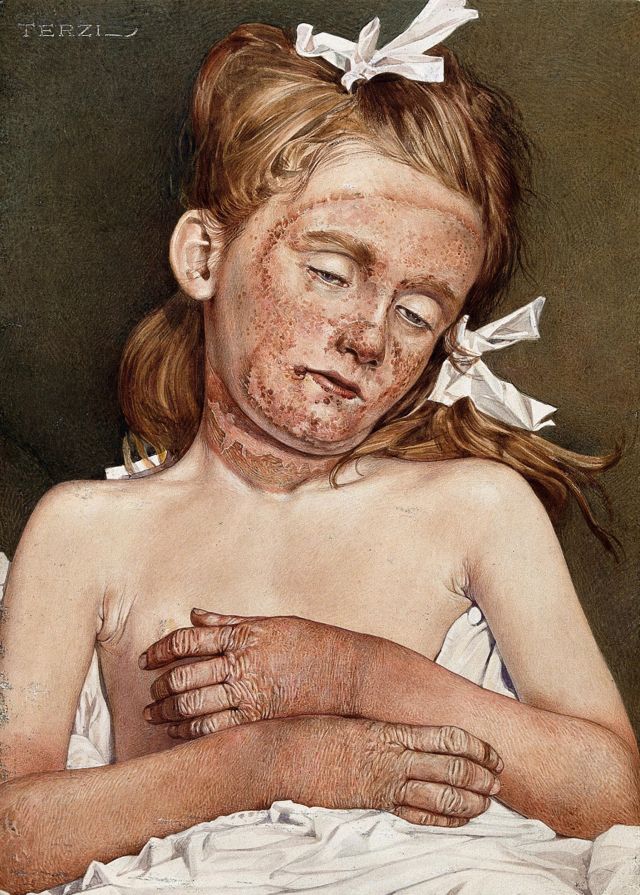 'Uma menina na casa de repouso de Londres sofrendo de pelagra crônica', aquarela de A.J.E. Terci, 1925