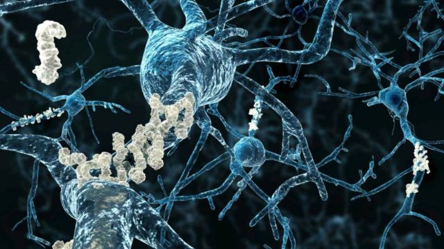 Se muestran placas de amiloide en los axones de las neuronas afectadas por la enfermedad de Alzheimer
