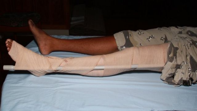 Pressure immobilisation technique