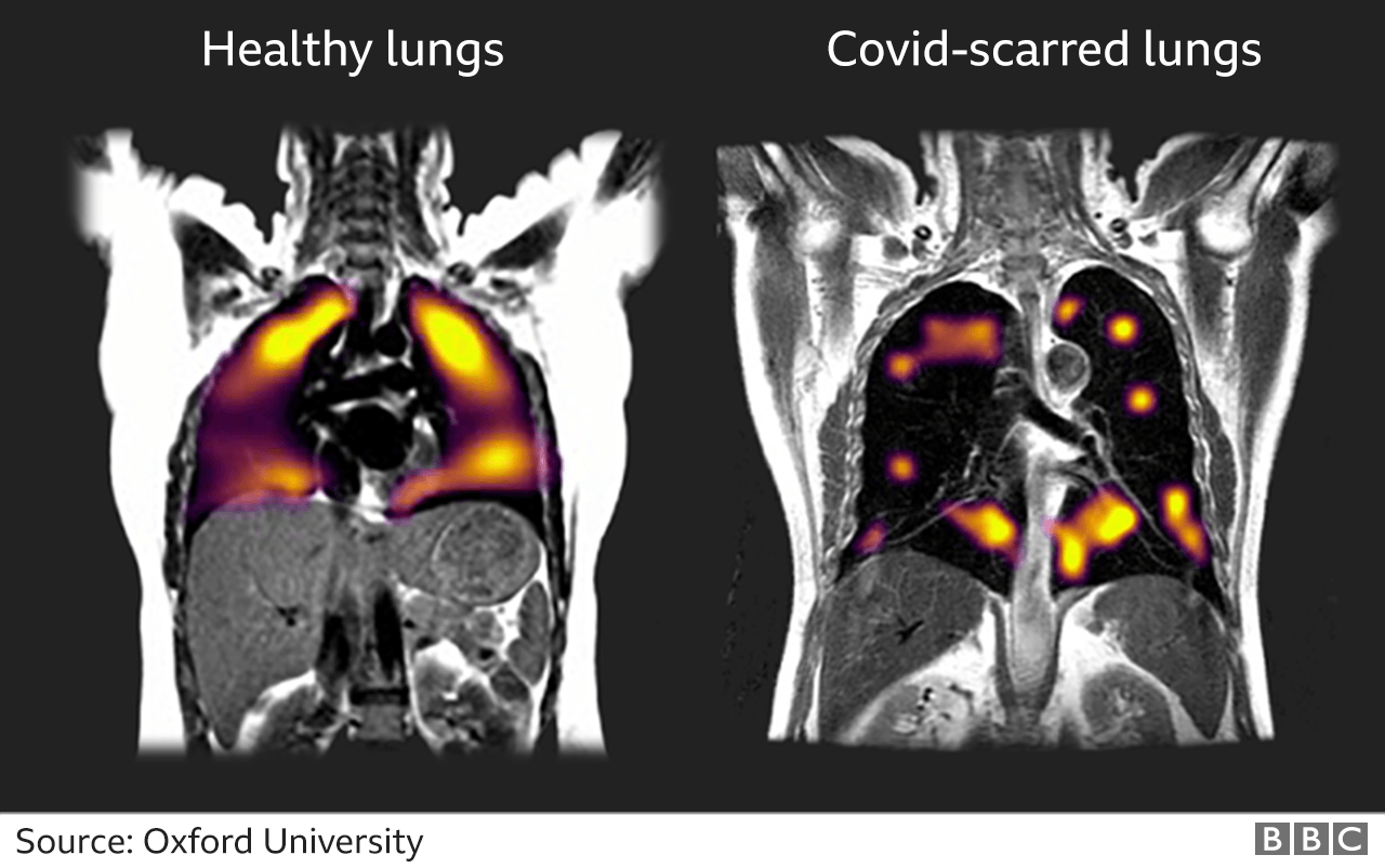 Imagens ativadas por gás de xenônio mostrando pulmões saudáveis ​​e pulmões com manchas de Kovid