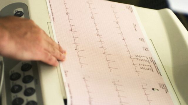 O eletrocardiograma é um exame que mede a atividade elétrica do coração. Os resultados vêm na forma de curvas, como na imagem, e são interpretados pelos médicos
