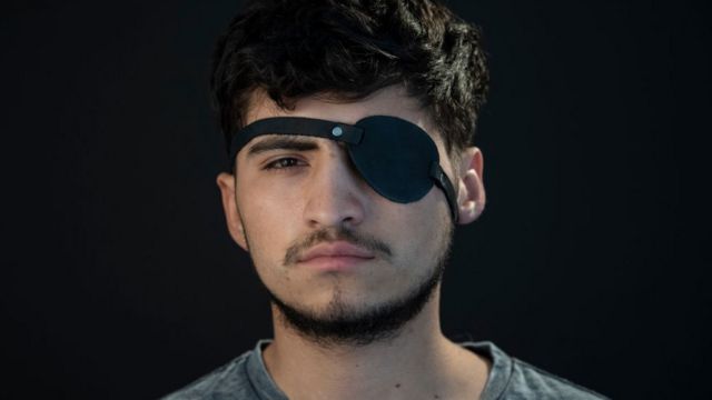 One of those injured in one eye during the demonstrations photographed with an eye patch.