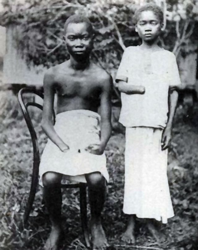Les fonctionnaires coloniaux ont amputé et mutilé des Congolais, y compris des enfants, en guise de punition