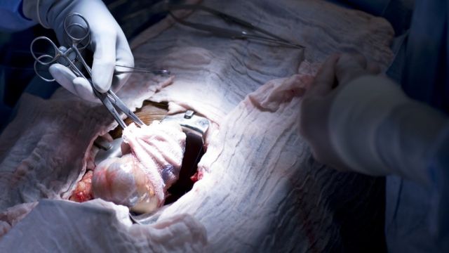 Kidney transplant