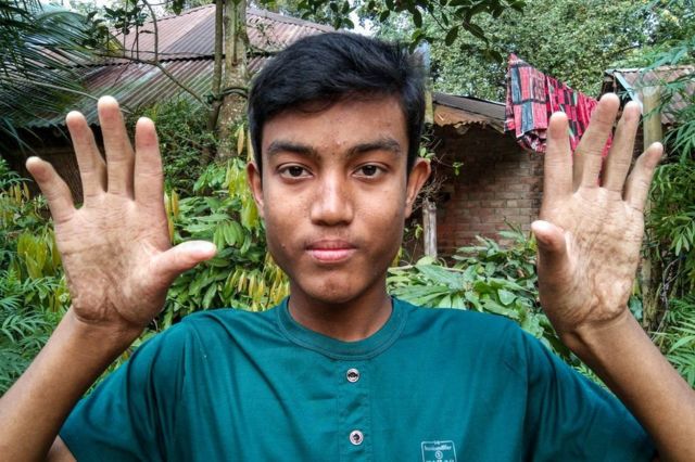 අපු ගේ බාල සොයුරු අනු ද මෙම ජාන විපර්යාසයට ලක්වී සිටී