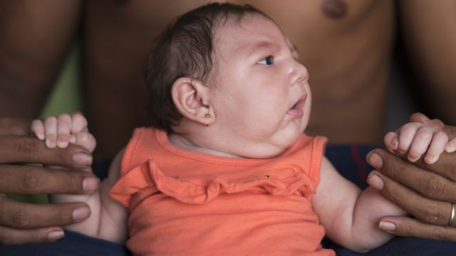 Un bebé con microcefalia ligada al virus del Zika