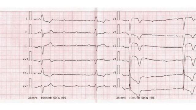 மாரடைப்பு