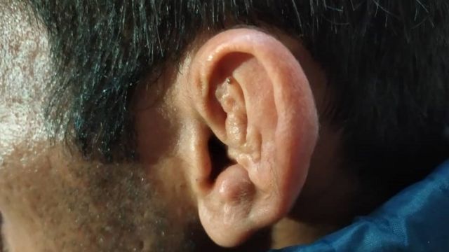 Aras's left ear was torn in three places, a picture of his ear after three surgeries