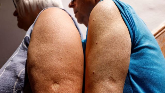 Marca de vacina contra a varíola no braço de dois idosos
