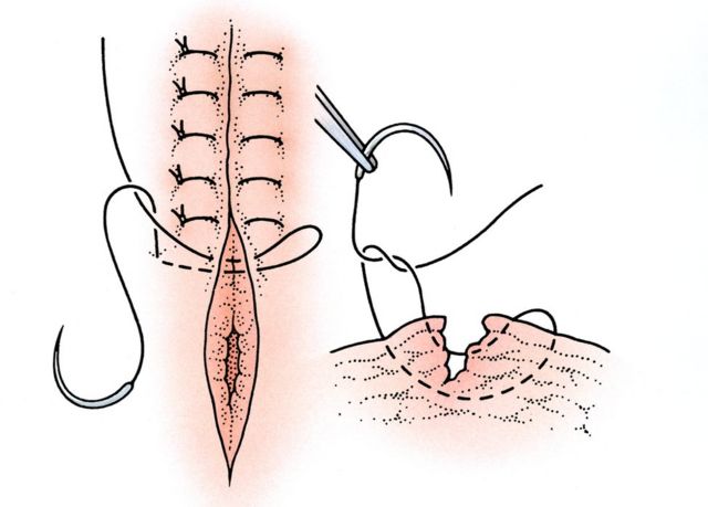 Sutura perineal