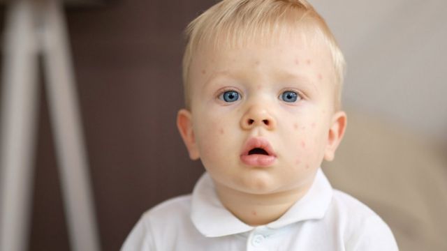 Bebé con erupción cutánea en el rostro.