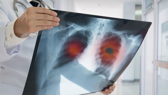 Un doctor examina una radiografía con cáncer de pulmón.