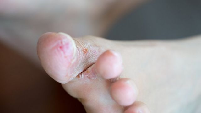 Herida en el dedo del pie