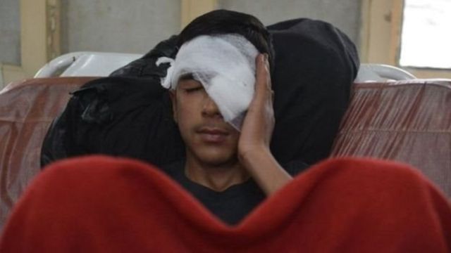 पेलेट गन से घायल कश्मीरी किशोर