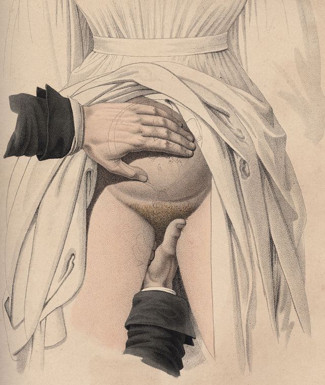 Desenho de Jacques-Pierre Maygrier, de 1840, que mostra um médico usando as mãos para fazer um parto