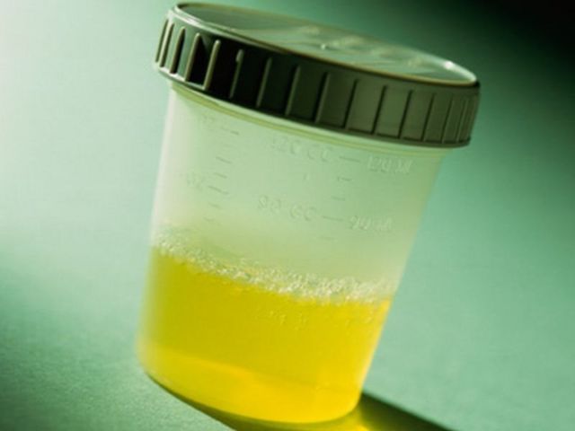 Mkojo mzito wenye harufu kali na damu ni moja ya dalili za maambukizi ya UTI