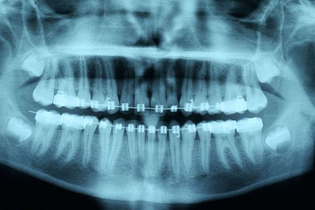 Radiografía de una boca con frenillos.