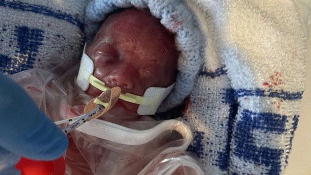 Smallest baby at birth' home after 13 months in hospital - BBC News