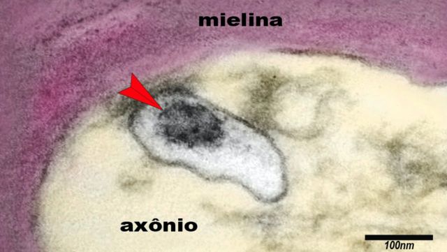 A imagem mostra um axônio de um neurônio do cérebro de uma criança com síndrome inflamatória multissistêmica pediátrica (SIM-P). A seta aponta o vírus SARS-CoV-2 em uma vesícula no citoplasma do axônio.