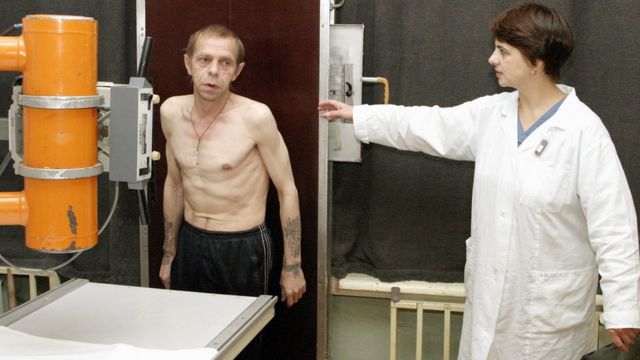 Мужчина на флюорографии