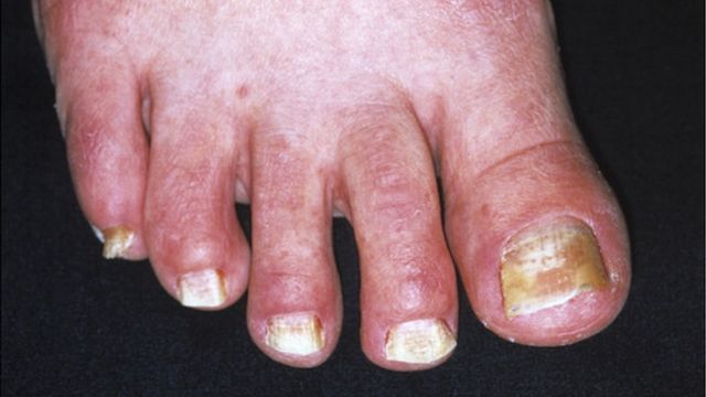 toe nail fungus australia