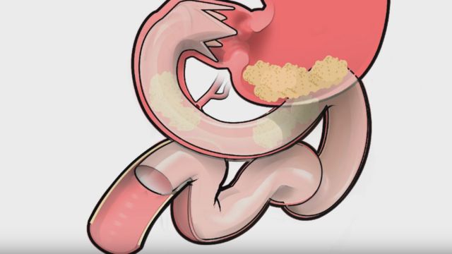 ilustración de cómo funciona la funda intestinal Endobarrier