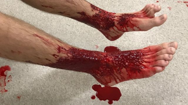 Sam Kanizay's bitten leg