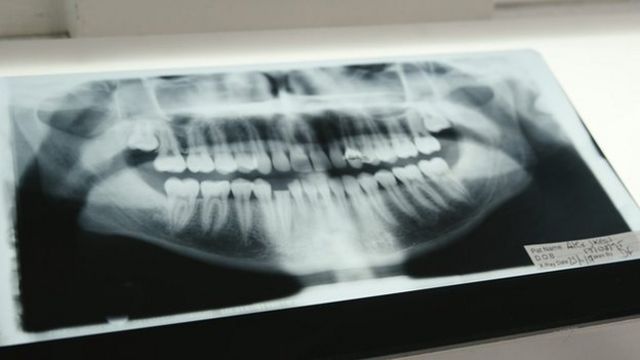 An x-ray of Alex's mouth showing his broken teeth