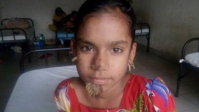 সাহানা খাতুনের মুখে, কানে, নাকে শেকড়ের মতো কিছু উপসর্গ ছিল