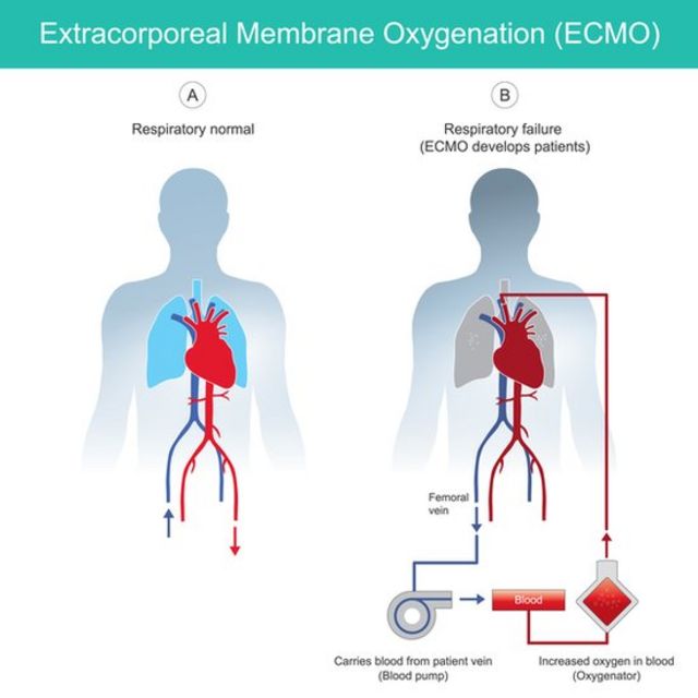 ECMO treatment patient