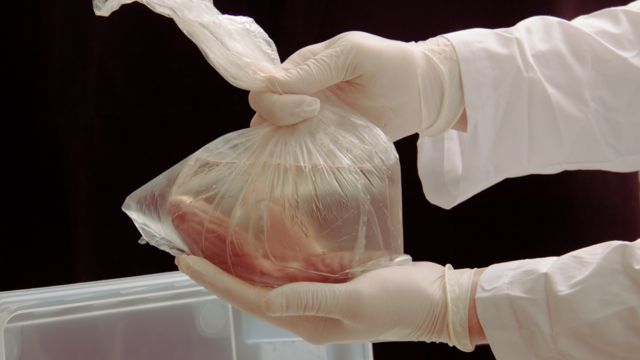Órgano en una bolsa preparado para trasplante