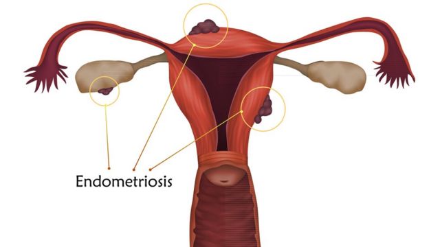 CRÉDITO,GETTY IMAGES: A endometriose é a presença de tecido do revestimento do útero - o endométrio - fora do útero
