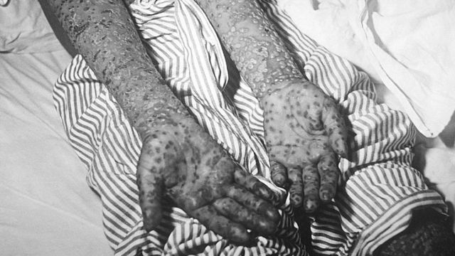 Lesões da varíola