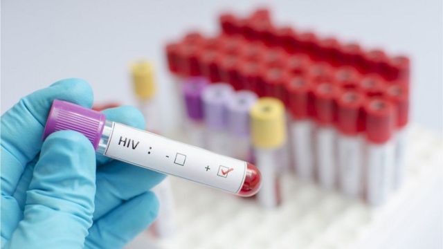 tubo de exame de sangue com HIV positivo