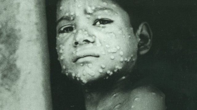 Foto histórica de un niño con viruela