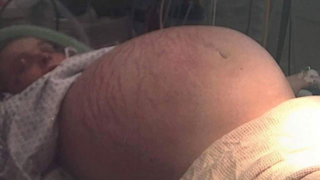 Un quiste de ovario de 26 kilos: la mujer que pensaba que solo "estaba  gorda" cuando le decían que estaba embarazada - BBC News Mundo