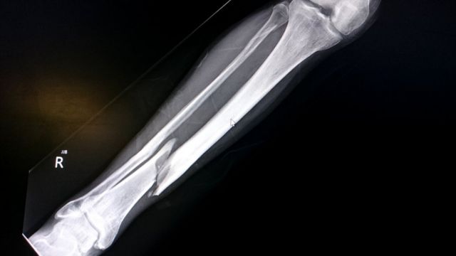 Реабилитация после перелома лучевой кости