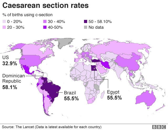 Graphic shows Caesarean section rates around the world using data from 2015