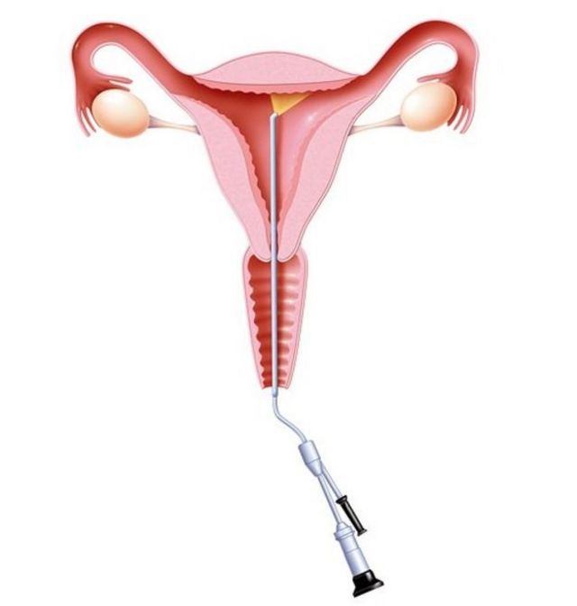 Hysteroscopy wey dey examine inside di womb