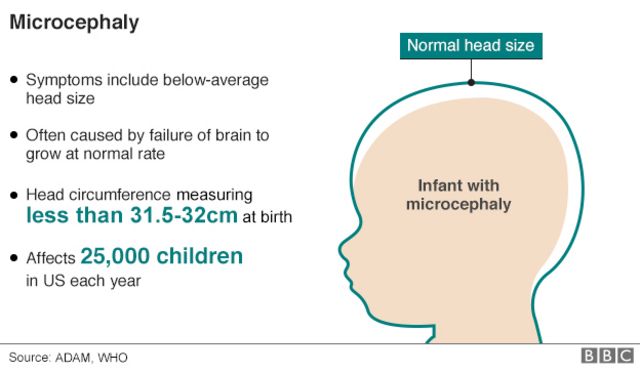 米国では毎年2万5000人の赤ちゃんが小頭症と診断されている