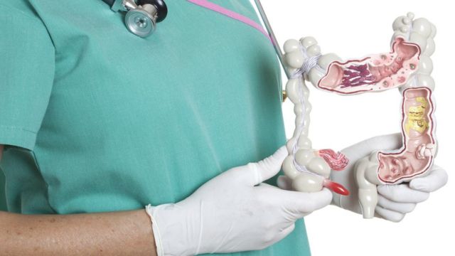 மலக்குடல் புற்றுநோய்