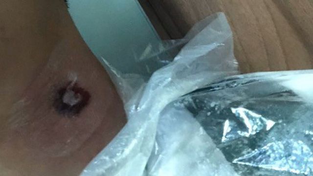 Vết thương do đạn cao su ở trên cổ Elvis sau khi đụng độ với cảnh sát ở Mong Kok hồi tháng 9