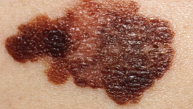 Typical mole of a melanoma