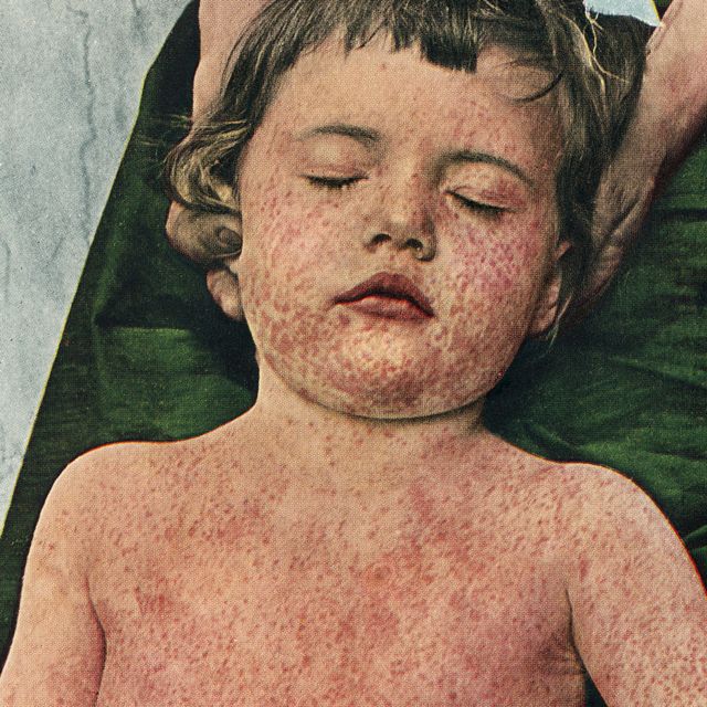 Imagen histórica de niña con sarampión