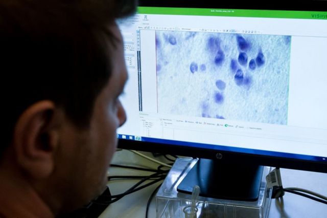 Un investigador examina una muestra de cerebro en el Hospital de Bispebjerg en Copenhague