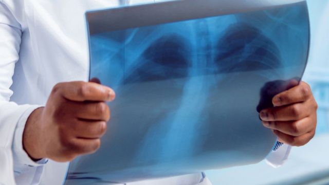 फोक्सोको एक्सरे