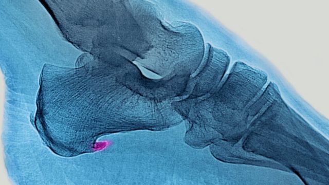 Fascitis plantar