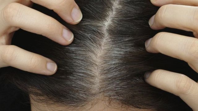 முடி நரைத்தல்