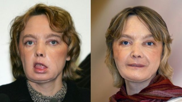 Isabelle Dinoire