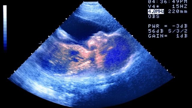 Ultrassonografia de um bebê no útero